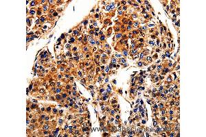 Immunohistochemistry of Human liver cancer using APLP1 Polyclonal Antibody at dilution of 1:10 (APLP1 antibody)