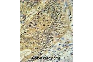RPS15A Antibody (N-term) (ABIN650999 and ABIN2840032) IHC analysis in formalin fixed and paraffin embedded colon carcinoma followed by peroxidase conjugation of the secondary antibody and DAB staining. (RPS15A antibody  (N-Term))