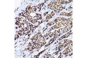 Immunohistochemistry of paraffin-embedded human breast cancer using VD Rabbit pAb (ABIN7271337) at dilution of 1:150 (40x lens). (VDAC2 antibody  (AA 1-100))