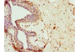 Immunohistochemistry of paraffin-embedded human breast cancer using ABIN7165737 at dilution of 1:100 (FAIM2 antibody  (AA 1-105))