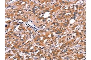 The image on the left is immunohistochemistry of paraffin-embedded Human thyroid cancer tissue using ABIN7190640(FDCSP Antibody) at dilution 1/25, on the right is treated with synthetic peptide. (FDCSP antibody)