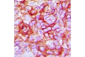 Immunohistochemical analysis of Taurine Transporter staining in human breast cancer formalin fixed paraffin embedded tissue section. (TAUT antibody  (C-Term))