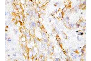 Immunohistochemical staining of paraffin-embedded human lung cancer tissue section with DEFB1 polyclonal antibody . (beta Defensin 1 antibody  (C-Term))