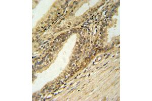 DFFB Antibody (N-term) (ABIN653798 and ABIN2843079) IHC analysis in formalin fixed and paraffin embedded prostate carcinoma followed by peroxidase conjugation of the secondary antibody and DAB staining. (DFFB antibody  (N-Term))
