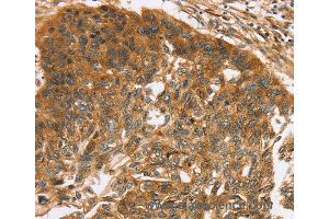 Immunohistochemistry of Human esophagus cancer using TNFSF15 Polyclonal Antibody at dilution of 1:40