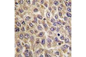 IHC analysis of FFPE human hepatocarcinoma tissue stained with ILK antibody (ILK antibody  (AA 225-253))