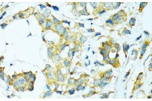 Immunohistochemistry of paraffin-embedded Human breast cancer using CYP2B6 Polyclonal Antibody at dilution of 1:100 (40x lens). (CYP2B6 antibody)