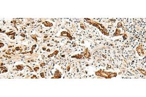 Immunohistochemistry of paraffin-embedded Human prost at e cancer tissue using GPR160 Polyclonal Antibody at dilution of 1:35(x200) (GPR160 antibody)