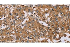 Immunohistochemistry of paraffin-embedded Human liver cancer using DDAH1 Polyclonal Antibody at dilution of 1:50 (DDAH1 antibody)