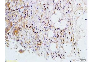 Formalin-fixed and paraffin embedded human colon carcinoma labeled with Rabbit Anti-MMP-7 Polyclonal Antibody, Unconjugated  at 1:200 followed by conjugation to the secondary antibody and DAB staining.