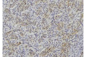 ABIN6277021 at 1/100 staining Human lung cancer tissue by IHC-P.