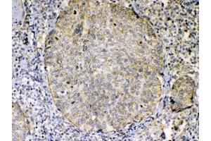 IHC testing of FFPE human lung cancer tissue with TNFSF18 antibody at 1ug/ml.