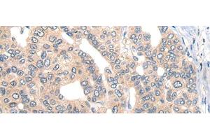 Immunohistochemistry of paraffin-embedded Human liver cancer tissue using CORO2B Polyclonal Antibody at dilution of 1:50(x200) (CORO2B antibody)