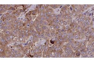 ABIN6273853 at 1/100 staining Human liver cancer tissue by IHC-P. (G Protein-Coupled Receptor 133 antibody  (Internal Region))