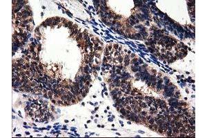 Immunohistochemical staining of paraffin-embedded Human liver tissue using anti-ADSL mouse monoclonal antibody. (Adenylosuccinate Lyase antibody)