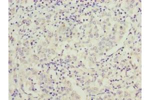 Immunohistochemistry of paraffin-embedded human lung cancer using ABIN7166922 at dilution of 1:100 (C9orf64 antibody  (AA 182-341))