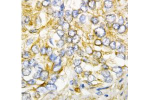 Anti-AIMP2/p38 antibody, IHC(P) IHC(P): Human Rectal Cancer Tissue (AIMP2 antibody  (Middle Region))