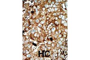Formalin-fixed and paraffin-embedded human hepatocellular carcinoma tissue reacted with PFKFB3 polyclonal antibody  , which was peroxidase-conjugated to the secondary antibody, followed by AEC staining. (PFKFB3 antibody  (C-Term))