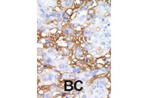 Formalin-fixed and paraffin-embedded human cancer tissue reacted with MAP4K1 polyclonal antibody  , which was peroxidase-conjugated to the secondary antibody, followed by DAB staining. (MAP4K1 antibody  (C-Term))