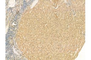 ABIN7094478 and ABIN7098526 at 1/100 staining Human liver cancer and adjacent normal tissues by IHC-P.