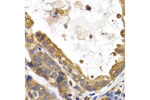 Immunohistochemistry of paraffin-embedded human stomach cancer using GYS1 antibody at dilution of 1:200 (400x lens). (Glycogen Synthase 1 antibody)