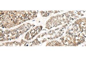 Immunohistochemistry of paraffin-embedded Human esophagus cancer tissue using CCDC181 Polyclonal Antibody at dilution of 1:50(x200)