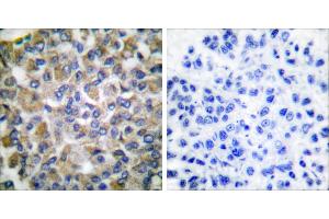 Peptide - +Immunohistochemical analysis of paraffin-embedded human breast carcinoma tissue using GRP75 antibody (#C0216). (HSPA9 antibody)