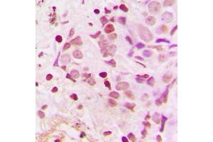 Immunohistochemical analysis of TSHZ1 staining in human breast cancer formalin fixed paraffin embedded tissue section. (TSHZ1 antibody  (C-Term))