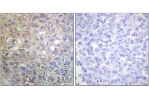 Immunohistochemistry analysis of paraffin-embedded human breast carcinoma tissue, using FGFR1 (Ab-766) Antibody.