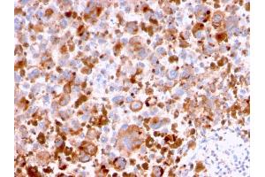 Formalin-fixed, paraffin-embedded human Melanoma stained with CD63 Mouse Monoclonal Antibody (LAMP3/2788). (CD63 antibody  (AA 100-197))