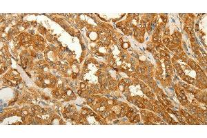 Immunohistochemistry of paraffin-embedded Human thyroid cancer tissue using RAB35 Polyclonal Antibody at dilution 1:50 (RAB35 antibody)