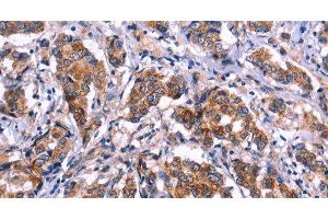 Immunohistochemistry of paraffin-embedded Human breast cancer tissue using EIF2AK4 Polyclonal Antibody at dilution 1:50 (GCN2 antibody)