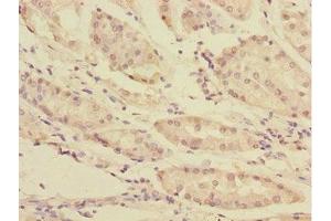 Immunohistochemistry of paraffin-embedded human gastric cancer using ABIN7166196 at dilution of 1:100 (TOB2 antibody  (AA 1-70))