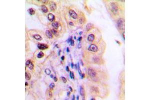 Immunohistochemical analysis of USP32 staining in human lung cancer formalin fixed paraffin embedded tissue section. (USP32 antibody  (Center))