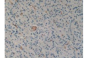 DAB staining on IHC-P; Samples: Human Glioma Tissue (Urotensin 2 antibody  (AA 20-120))