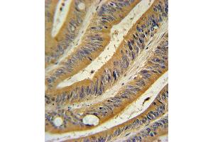 WNT10B Antibody (Center) (ABIN390524 and ABIN2840875) immunohistochemistry analysis in formalin fixed and paraffin embedded human colon carcinoma followed by peroxidase conjugation of the secondary antibody and DAB staining. (WNT10B antibody  (AA 193-222))