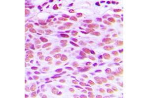 Immunohistochemical analysis of GATA4 staining in human breast cancer formalin fixed paraffin embedded tissue section. (GATA4 antibody  (Center))