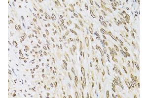 Immunohistochemistry of paraffin-embedded human uterine cancer using EMD antibody (ABIN6290347) at dilution of 1:100 (40x lens). (Emerin antibody)