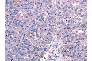 The image on the left is immunohistochemistry of paraffin-embedded Human breast cancer tissue using ABIN7131486(TRIM49 Antibody) at dilution 1/40, on the right is treated with fusion protein. (TRIM49 antibody)