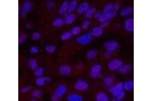 Immunofluorescence analysis of Human liver cancer tissue using XRCC4 Monoclonal Antibody at dilution of 1:200. (XRCC4 antibody)