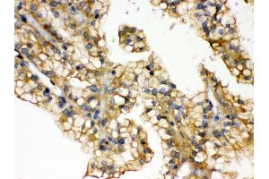 Anti- Aquaporin 2 Picoband antibody, IHC(P) IHC(P): Human Kidney Cancer Tissue (AQP2 antibody  (C-Term))