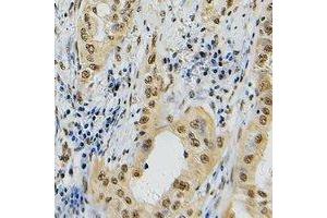 Immunohistochemical analysis of Topoisomerase 2 alpha staining in human lung cancer formalin fixed paraffin embedded tissue section. (Topoisomerase II alpha antibody  (C-Term))
