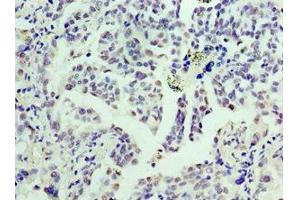 Immunohistochemistry of paraffin-embedded human lung cancer using ABIN7153394 at dilution of 1:100