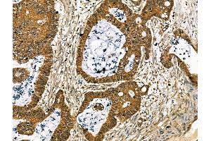 ABIN7094420 and ABIN7098467 at 1/100 staining Human colorectal cancer by IHC-P.