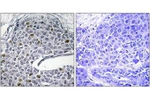 Immunohistochemistry analysis of paraffin-embedded human lung carcinoma tissue, using IRF3 (Ab-385) Antibody. (IRF3 antibody  (AA 351-400))