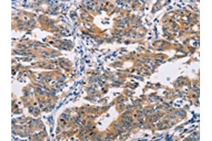 The image on the left is immunohistochemistry of paraffin-embedded Human gastic cancer tissue using ABIN7128293(AGPAT4 Antibody) at dilution 1/25, on the right is treated with fusion protein. (AGPAT4 antibody)