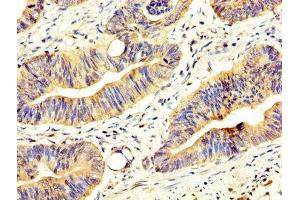 IHC image of ABIN7144916 diluted at 1:200 and staining in paraffin-embedded human colon cancer performed on a Leica BondTM system. (CCL17 antibody  (AA 559-715))