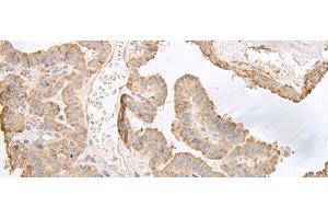 Immunohistochemistry of paraffin-embedded Human thyroid cancer tissue using PFKM Polyclonal Antibody at dilution of 1:60(x200) (PFKM antibody)
