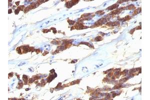 Formalin-fixed, paraffin-embedded human Thyroid Carcinoma stained with Thyroglobulin Monoclonal Antibody (SPM221). (Thyroglobulin antibody)