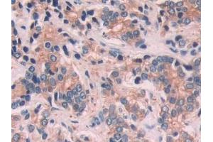 Detection of KRT6C in Human Prostate cancer Tissue using Polyclonal Antibody to Keratin 6C (KRT6C)